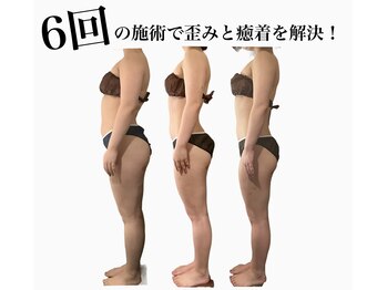 クリア(CLEAR)/リヴァイセルボディ　