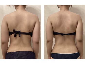 ルシエル ハカタ(Luciel HAKATA)/痩身120分1回の変化(20代) 