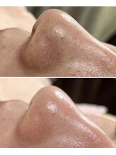 ララ(LALA)/姪浜フェイシャル・毛穴洗浄