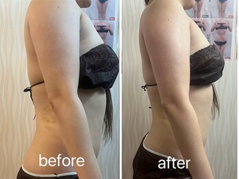 ヤン リン 整体(Yang Ling 整体)/二の腕も1回で変化あり♪