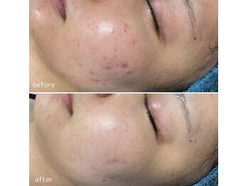 アンドワイ バイ サロンリーナ(&y by Salon Lena)/【ハーブでお肌悩み解消】