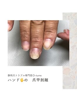 オツメ 静岡(O-tume)/爪甲剥離