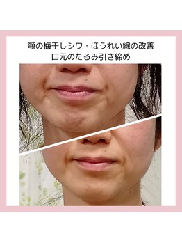 目元 口元のたるみ 眉間シワ改善専門サロン/口元のたるみ改善をしたい方向け