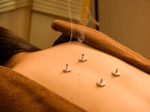 エクステンド鍼灸整体院(extend鍼灸整体院)/お灸