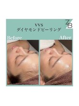 ザラハビューティー(ZARAHA Beauty)/VVSダイヤモンドピーリング
