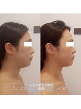 ミールーム(mi room)/レモンボトルフェイシャル