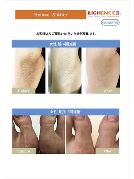 マル(MARU)/脱毛　～Before、After～