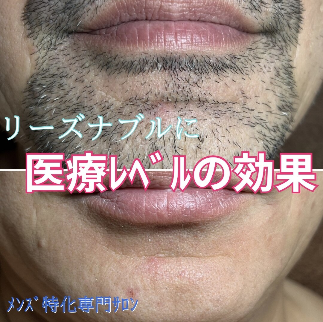 【ヒゲ脱毛】超冷却で痛みが苦手な方にも◎首から顔全体☆￥1980