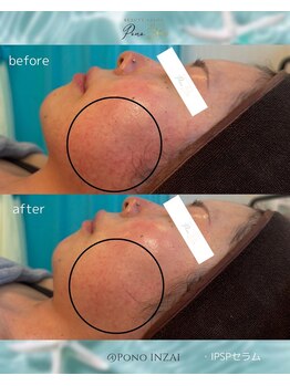 ポノ(Pono)/IPSPセラム☆一回の施術効果