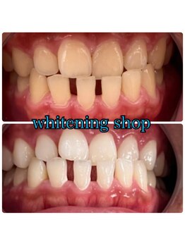 ホワイトニングショップ 越谷店/