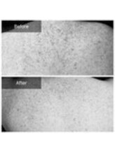 エミルカ 鹿児島店(EMILUCA)/ハーブピーリング　背中