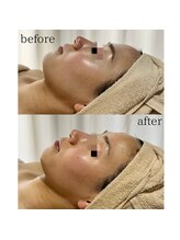 サロン ド ブラン アオヤマ(Salon de BLANC AOYAMA)/BLANC式小顔ソノケアコース