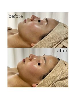 サロン ド ブラン アオヤマ(Salon de BLANC AOYAMA)/BLANC式小顔ソノケアコース