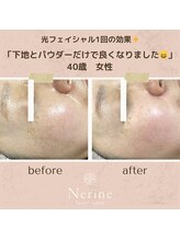 ネリネ(Nerine)/光フェイシャル1回の効果！