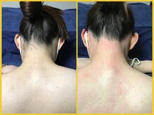 クラウン ジュエルズ(CROWN JEWELS)/【Wax脱毛】うなじ　正面 3