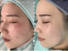 リメイクビューティークリニック(REMAKE BEAUTY CLINIC)の雰囲気（ハーブピーリングを超えた肌を育成する幹細胞ゴールドピーリング）