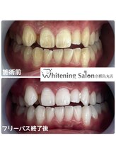 ホワイトニングサロン 京都烏丸店/ホワイトニング施術例