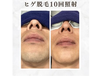 ボゴス 天白店(BOGOSS)/【ヒゲ脱毛】施術写真