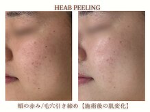 ミリ(MiLi)/赤み/ニキビケア/毛穴ケア