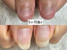 グラシナ なんば店/深爪/自爪育成/フィルイン