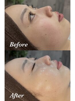 ミランオオサカ(MIRAN OSAKA)/毛穴引き締め、透明感UP