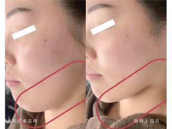 ラシック(LACHIC)/【たるみ改善】半永久小顔形成