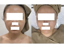 ミミ(MIMI)/３ヶ月でニキビ肌ここまで改善！