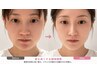 【お顔の浮腫みに】顔面調整 <鼻の高さ・ほうれい線・フェイスライン> 6800円