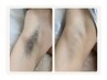 【☆超得☆】気になる匂い対策！ワキ脱毛初回￥1000(所要時間20分)メンズ脱毛