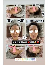 ヒナタ(HINATA)/原液100%幹細胞の力！