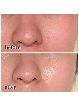 レピア つくば店(LEPIA)/夏や秋の肌トラブル