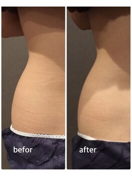 ビューティサロン ファイン(Fine)/40代/1回でウエストのくびれを