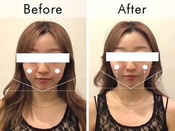 ハリラウンジ 梅田店(Hari Lounge)/美容鍼専門サロン Hari Lounge