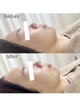 ラ フルール(La Fleur)/エアバリフェイシャルエステ