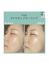 ザラハビューティー(ZARAHA Beauty)/VVSダイヤモンドピーリング