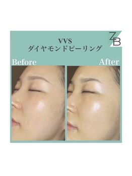 ザラハビューティー(ZARAHA Beauty)/VVSダイヤモンドピーリング
