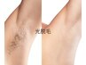 【８月学割キャンペーン】ひざ下＋ひじ下＋脇脱毛 7,000円→3,500円