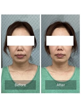 ハリナチュレ 那覇店(HARINATURE)/Before/After