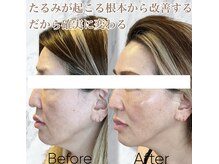 ルミライ(Lumirai)/たるみの根本改善！