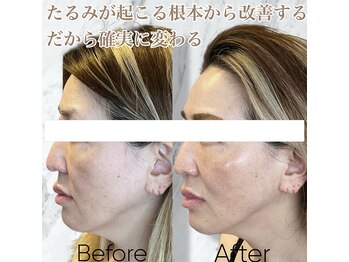 ルミライ(Lumirai)/たるみの根本改善!