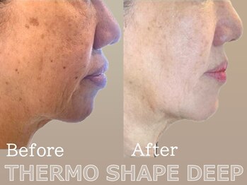 セレブリボーン 大阪ボーテ/サーモシェイプDEEP