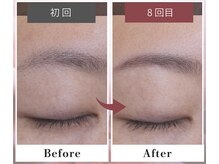 フルリール/【全顔脱毛】