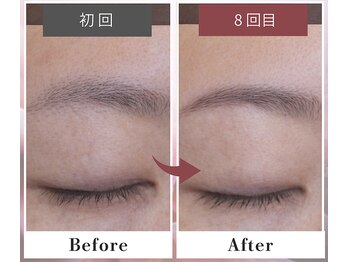 フルリール/【全顔脱毛】