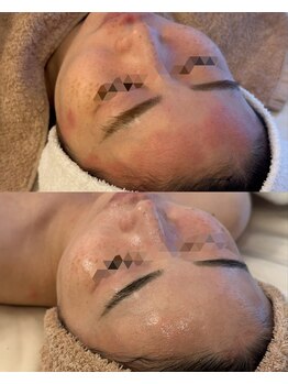 アマテラススキンラウンジ(Amatelas SKIN LOUNGE)の写真/◆本気の肌質改善◆乾燥・赤み・毛穴・ニキビ・エイジングに幅広いお悩み撃退オーダーメイドフェイシャル！