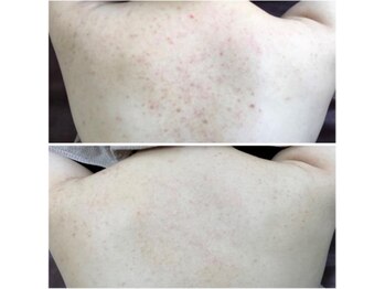 モッカ 北花田/背中ハーブ ニキビケア