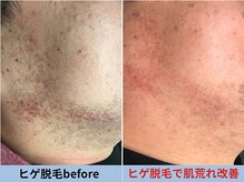 ミスターアンクール 鹿児島(Mr.uncoeur)/ヒゲ脱毛による肌荒れ改善