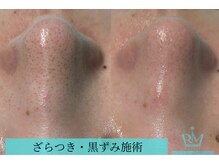 リメイククリニカルビューティー(Remake clinical beauty)/毛穴の黒ずみ、ざらつき改善