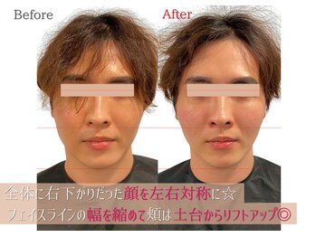 小顔製作所 心斎橋院/本格小顔矯正　解説３