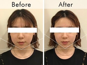 ハリラウンジ 梅田店(Hari Lounge)/美容鍼専門サロン Hari Lounge