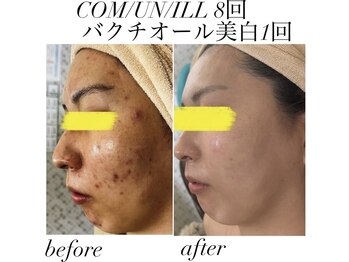 マスカレード 品川(Masquerade)/【症例写真】施術9回